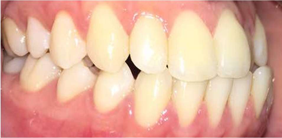 Class 3 Distalization - Before